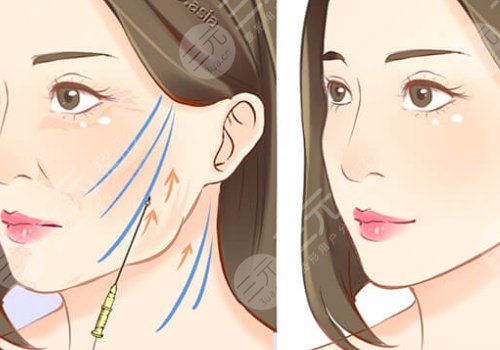 筋膜懸吊術(shù)適合多大年齡的？
