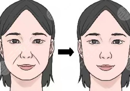 筋膜懸吊面部提升術(shù)恢復(fù)期多久？