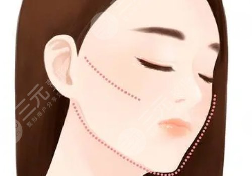 做完輪廓手術(shù)臉更大了怎么回事？