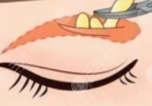 腫眼泡做雙眼皮埋線好還是割好？