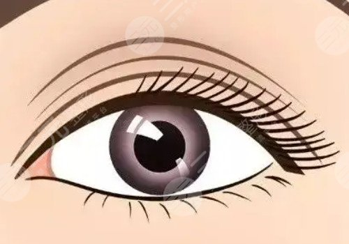 腫眼泡做雙眼皮埋線好還是割好？