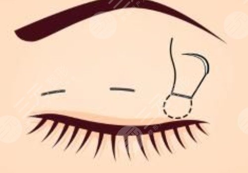 腫眼泡做雙眼皮埋線好還是割好？