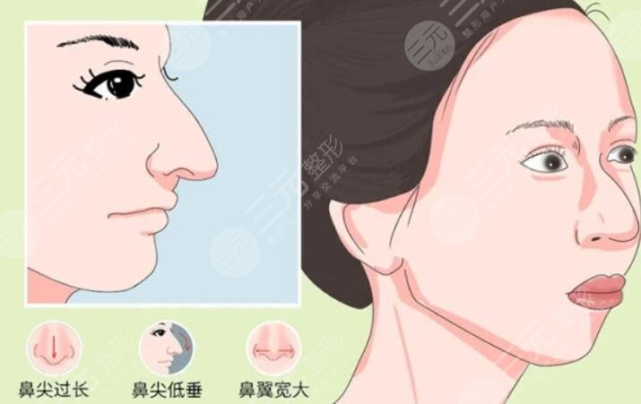 駝峰鼻