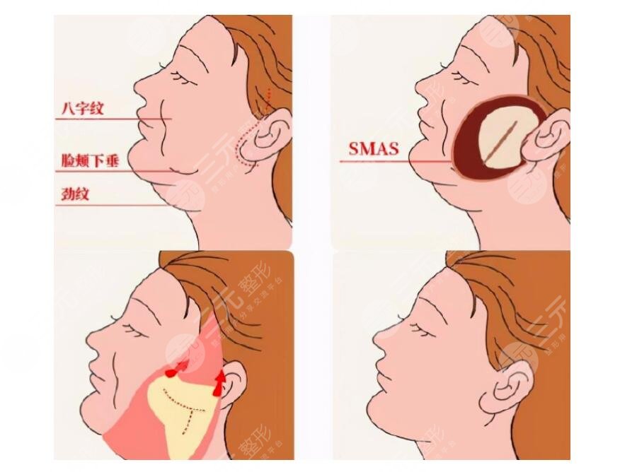 面部整形手術(shù)包括哪些