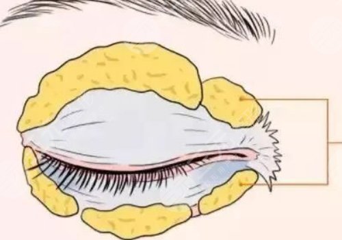 腫眼泡抽脂多少錢？