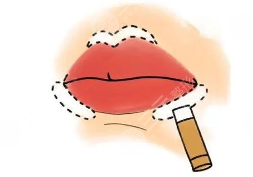唇部填充用脂肪還是玻尿酸？