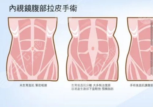 腹部拉皮和腹壁整形一樣嗎？