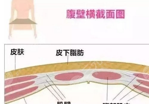 腹部拉皮和腹壁整形一樣嗎？