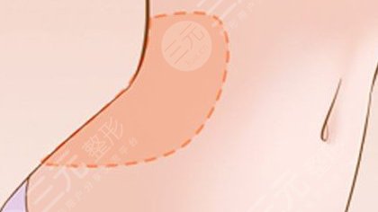 腰腹環(huán)吸包括哪幾個(gè)部位？