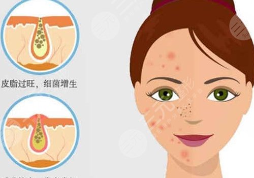t區(qū)反復(fù)長痘痘的原因是什么？