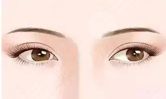 中國(guó)醫(yī)學(xué)科學(xué)院整形科雙眼皮案例