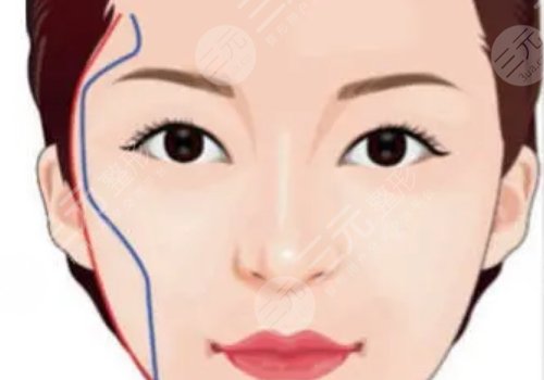 顴弓吸脂有什么后遺癥？