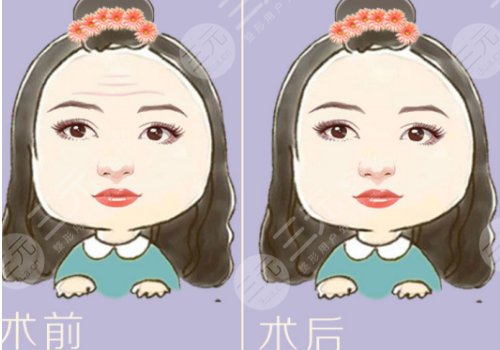抬頭紋怎么去除？