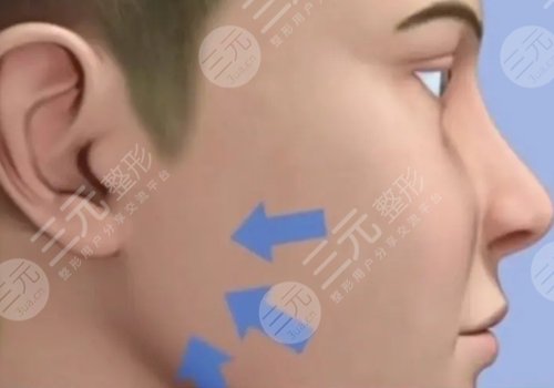外輪廓固定提升有哪些手術(shù)方案？