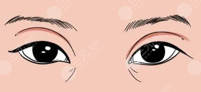 雙眼皮男生
