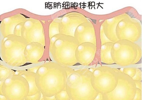 自體隆胸可以保持幾年？