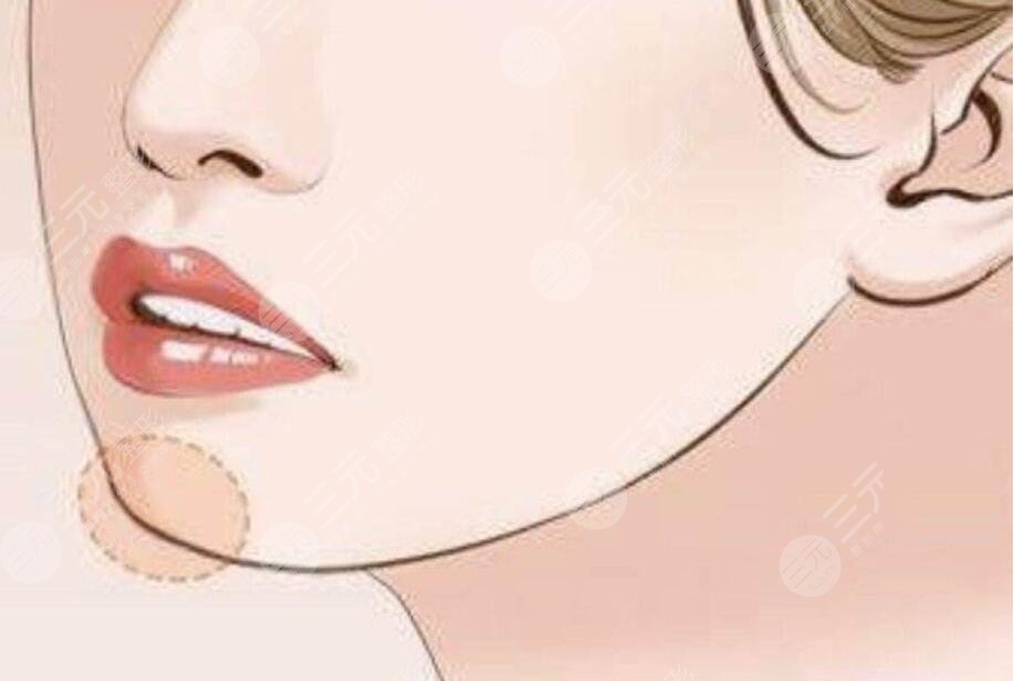 下巴整形要多少錢一針