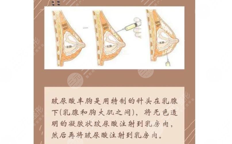 注射玻尿酸豐胸有危險(xiǎn)嗎？