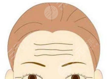 抬頭紋
