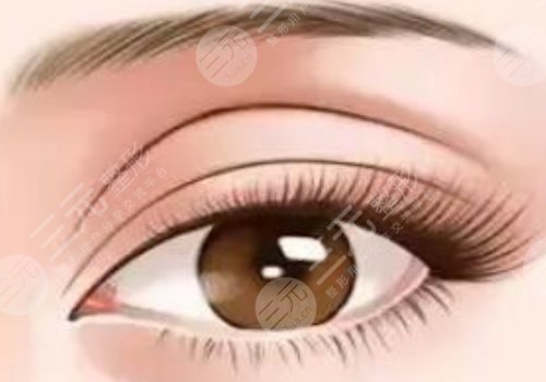 張殿祥雙眼皮修復(fù)案例