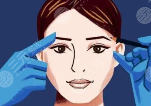 張殿祥雙眼皮修復(fù)案例