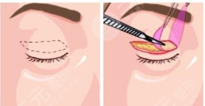 雙眼皮