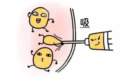腰腹環(huán)吸抽脂需要多久恢復(fù)期