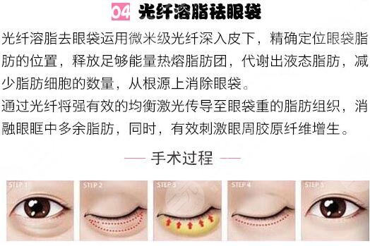 去眼袋