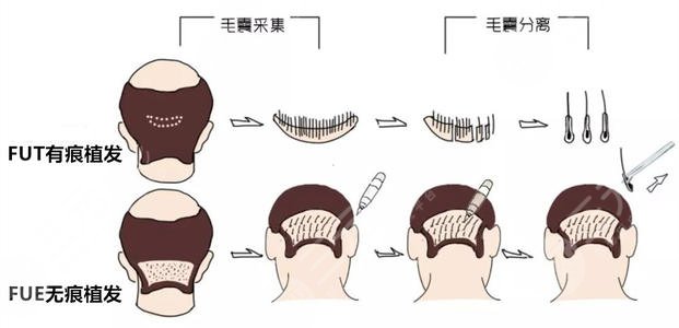 北京304醫(yī)院植發(fā)技術(shù)科普