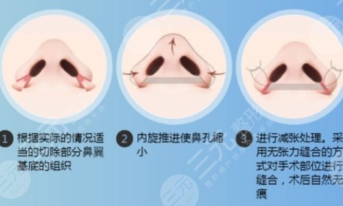 晉培紅縮鼻翼多少錢?