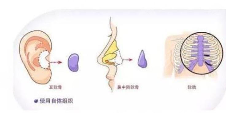 假體隆鼻