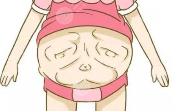 腹部整形