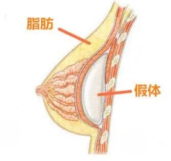 做完假體隆胸手術(shù)后求美者需要怎樣護(hù)理?