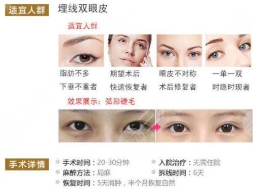 雙眼皮分為哪幾種做法？