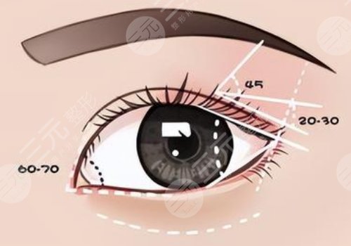 腫眼泡割雙眼皮案例