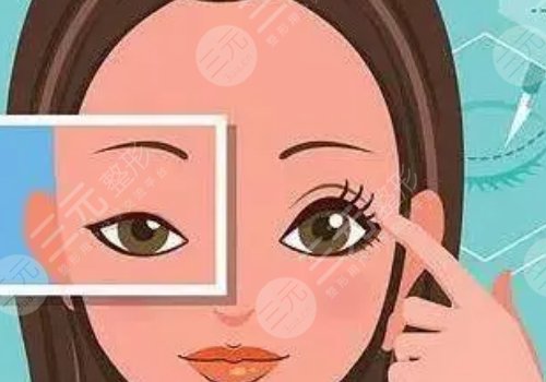 割雙眼皮需要多少錢一次