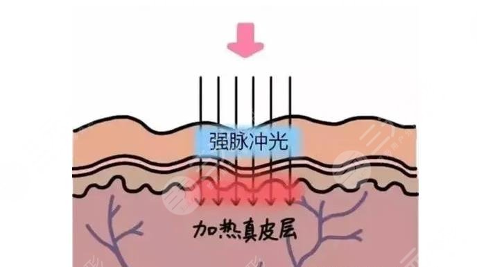 光子嫩膚m22和opt的區(qū)別