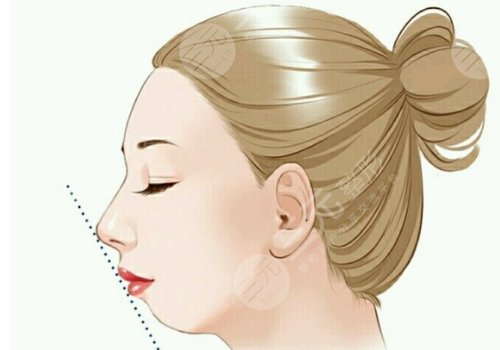 顴骨內(nèi)推加下頜角截骨多少錢