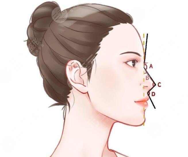 隆鼻維持的時間