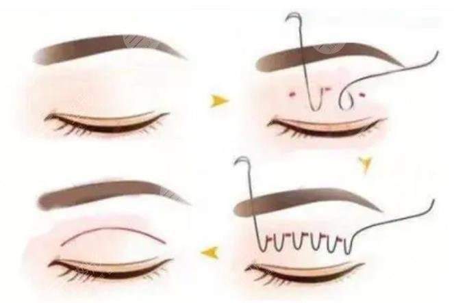 上海六院雙眼皮整形案例