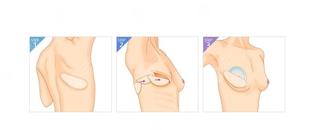 　乳房再造