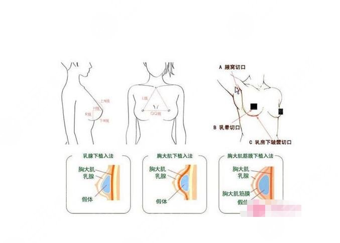 乳房再造