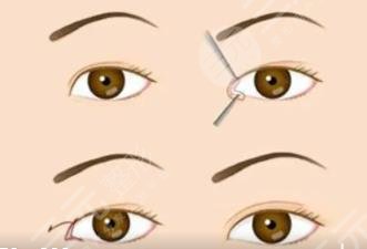雙眼皮修復(fù)