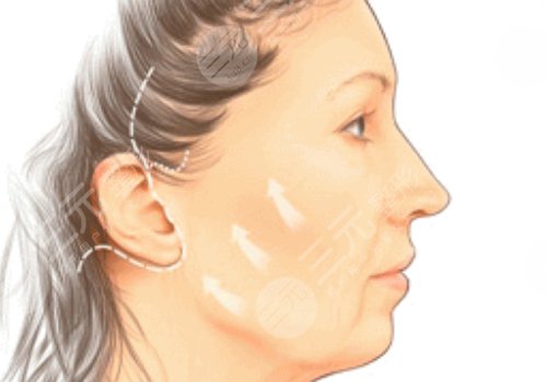 威海拉皮美容要多少錢(qián)