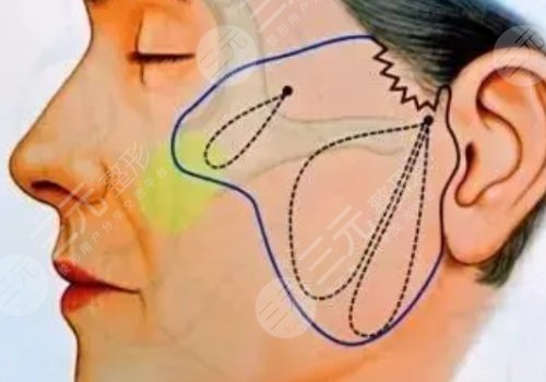 威海拉皮美容要多少錢(qián)