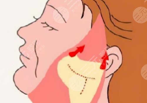 威海拉皮美容要多少錢(qián)