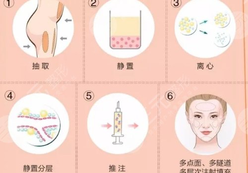 馮志丹面部脂肪填充案例