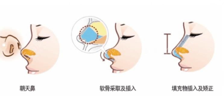 朝天鼻整形手術(shù).jpg