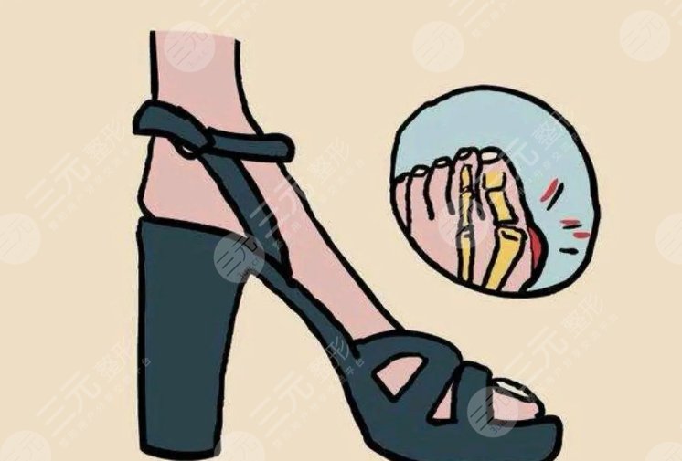 大腳骨外翻