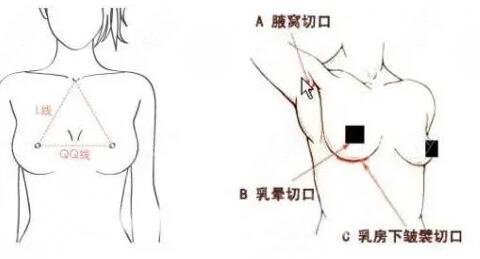 假體隆胸切口在什么位置比較好？常用三個(gè)切口位置，優(yōu)缺點(diǎn)告訴你！